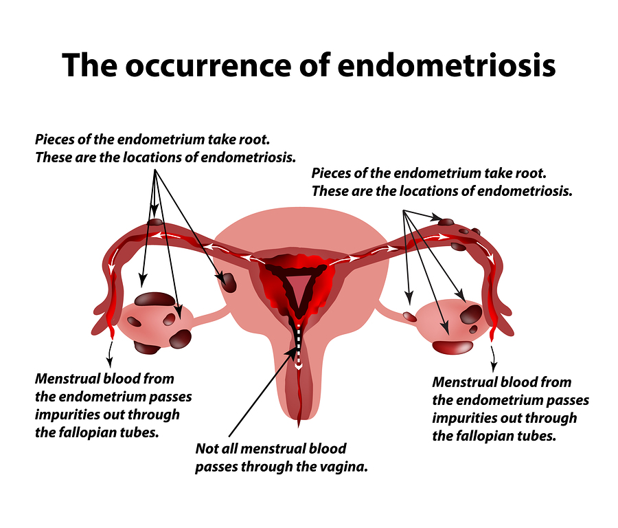 endometriosis and pregnancy