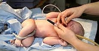 newborn-suctioning