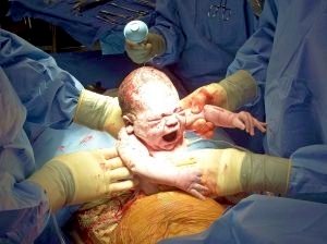 Planned Cesarean Section