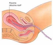 delivery of placenta